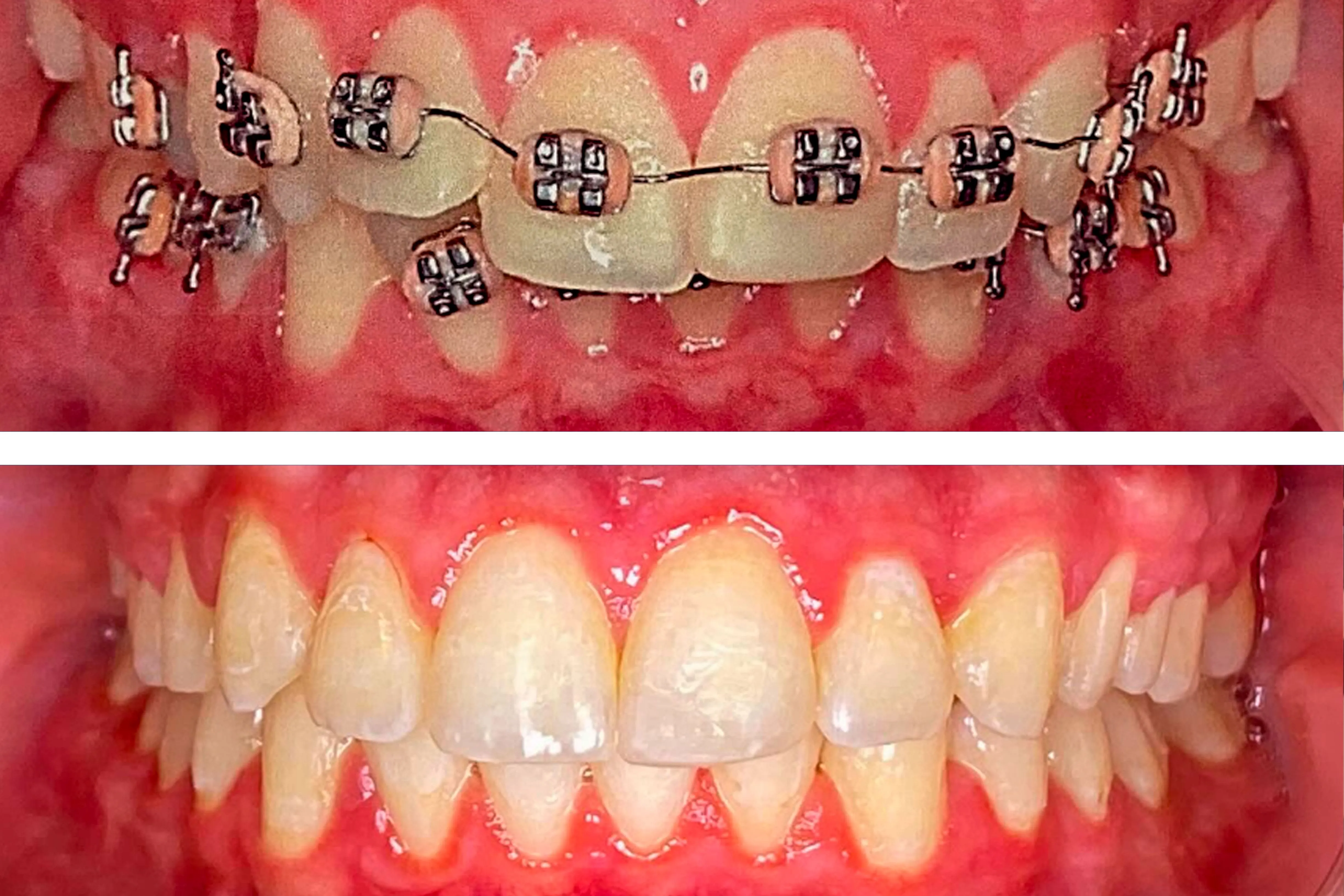 Ortodontia e alinhadores